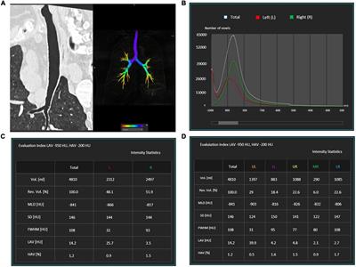 Radiological patterns and pulmonary function values of lung involvement in primary Sjögren’s syndrome: A pilot analysis